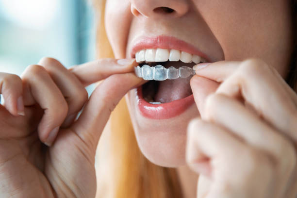 Complete Guide to Vinings Invisalign: Transform Your Smile Discreetly – GuestCountry